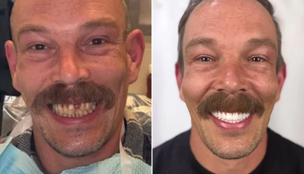 Before and after smile case: man’s worn, discolored teeth restored to a full white smile