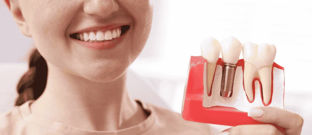 Can You Get a Dental Implant Years After Losing a Tooth? Essential Info and Options
