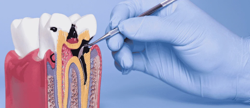 Illustration of a dental instrument treating decay in a tooth cross-section